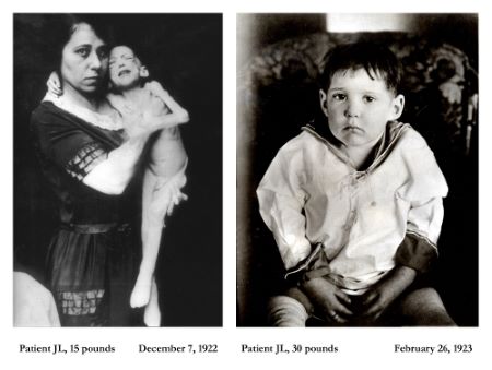 1922_1923-Patient-JL-Before-and-After-Insulin-Treatment